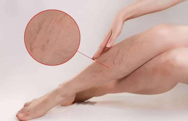 يوسيرين رغوة تستخدم لعلاج جفاف الجلد على القدمين لترطيب البشرة الجافة وتهدئتها تعمل على تحسين نعومة البشرة ومرونتها،وتساعد في علاج الجفاف والتشققات وتهدئة الحكة