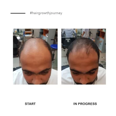 الموندهير سيروم تنشيط نمو الشعر الجديد بالإضافة إلى منع المزيد من تساقط الشعر وذلك في دراسة سريرية امتدت 90 يومًا.